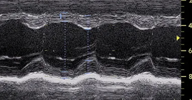 M-mode echocardiogram tracing of heart motion