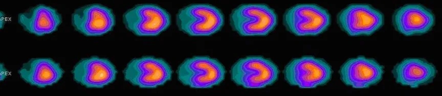 Nuclear heart perfusion study shown as rows of color scans