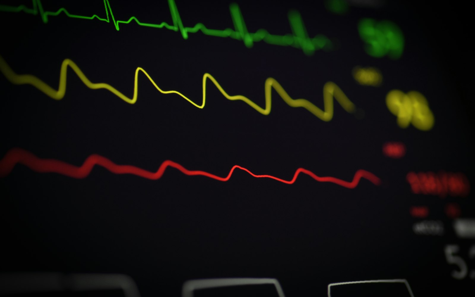 Cardiac rhythm displayed on a bedside monitor in a clinical setting