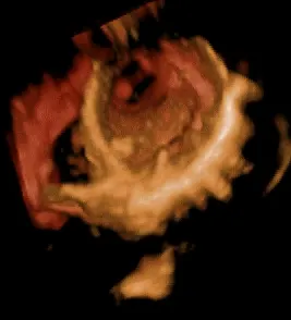Moving three-dimensional echocardiogram of the heart