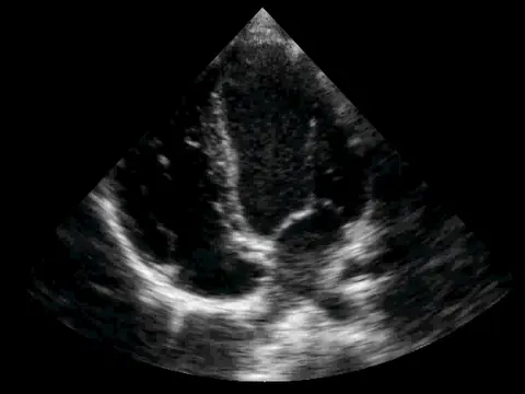 Moving echocardiogram in the apical four-chamber view, with the apex at the top